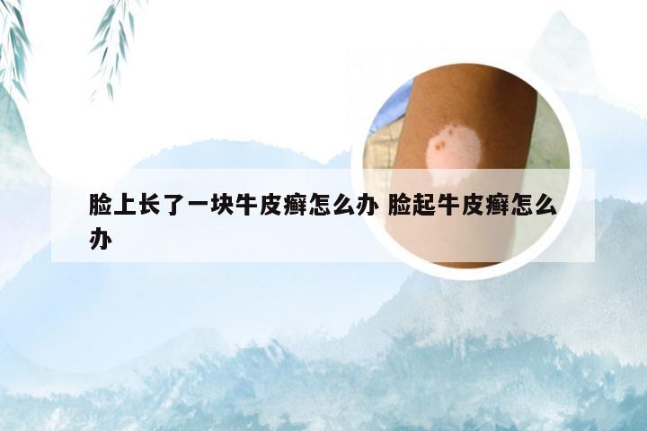脸上长了一块牛皮癣怎么办 脸起牛皮癣怎么办