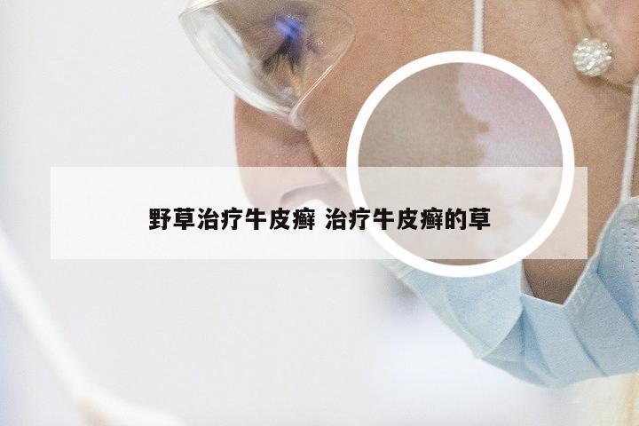 野草治疗牛皮癣 治疗牛皮癣的草