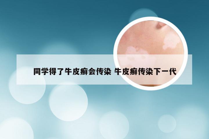 同学得了牛皮癣会传染 牛皮癣传染下一代