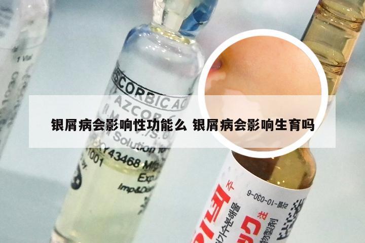 银屑病会影响性功能么 银屑病会影响生育吗