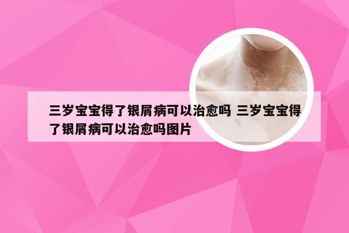 三岁宝宝得了银屑病可以治愈吗 三岁宝宝得了银屑病可以治愈吗图片