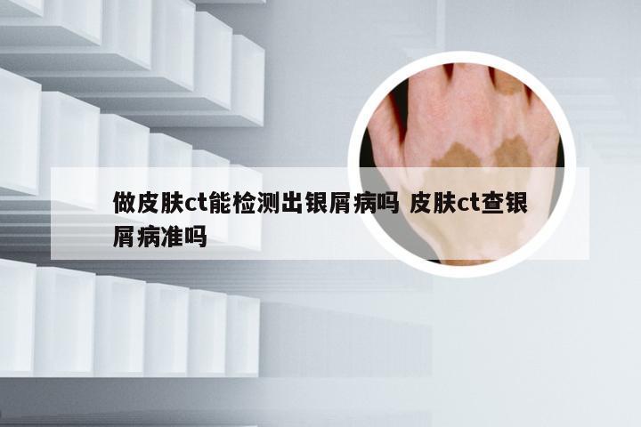 做皮肤ct能检测出银屑病吗 皮肤ct查银屑病准吗
