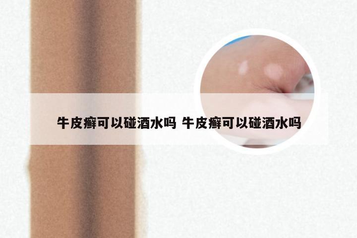 牛皮癣可以碰酒水吗 牛皮癣可以碰酒水吗