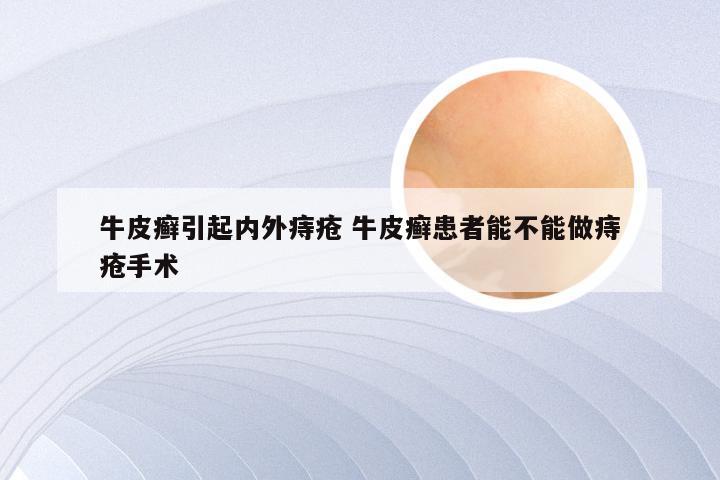 牛皮癣引起内外痔疮 牛皮癣患者能不能做痔疮手术