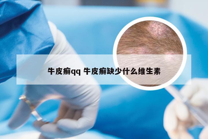 牛皮癣qq 牛皮癣缺少什么维生素