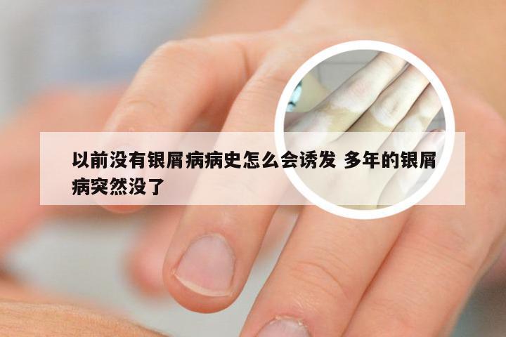 以前没有银屑病病史怎么会诱发 多年的银屑病突然没了
