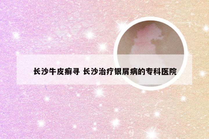 长沙牛皮癣寻 长沙治疗银屑病的专科医院