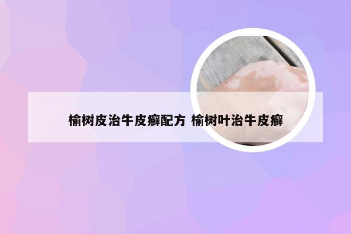 榆树皮治牛皮癣配方 榆树叶治牛皮癣