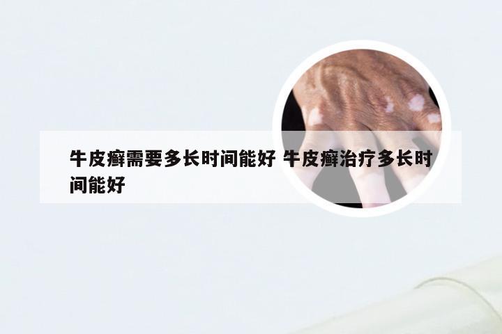 牛皮癣需要多长时间能好 牛皮癣治疗多长时间能好