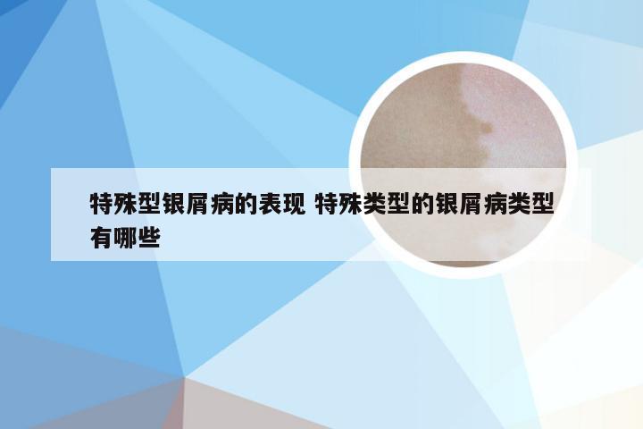 特殊型银屑病的表现 特殊类型的银屑病类型有哪些