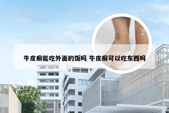 牛皮癣能吃外面的饭吗 牛皮癣可以吃东西吗