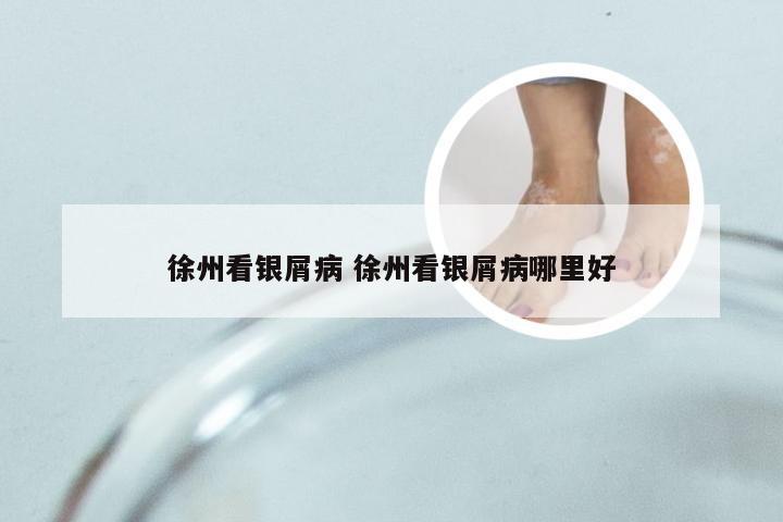 徐州看银屑病 徐州看银屑病哪里好