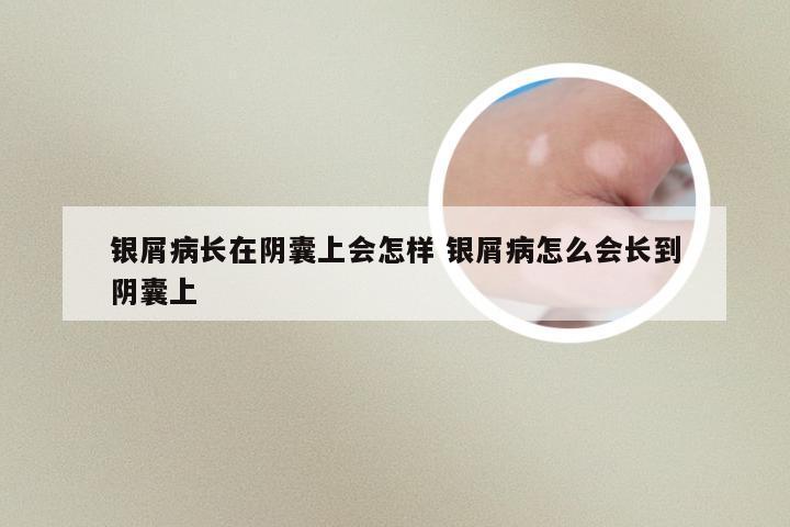 银屑病长在阴囊上会怎样 银屑病怎么会长到阴囊上