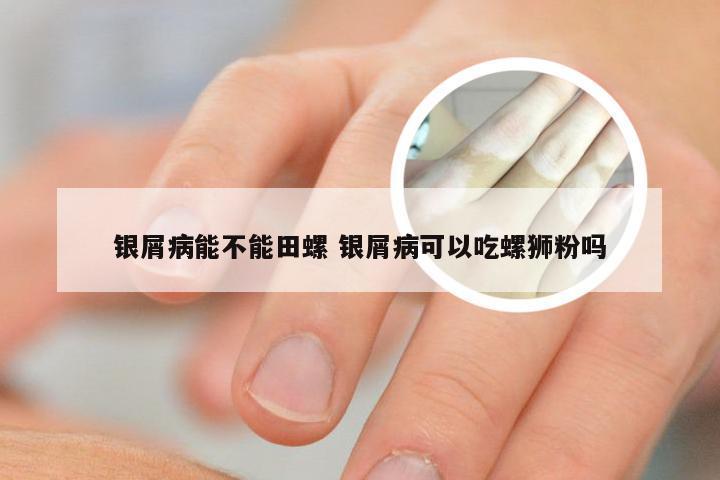 银屑病能不能田螺 银屑病可以吃螺狮粉吗