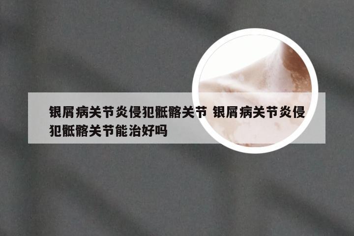 银屑病关节炎侵犯骶髂关节 银屑病关节炎侵犯骶髂关节能治好吗