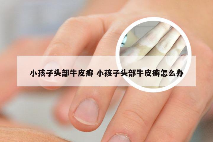 小孩子头部牛皮癣 小孩子头部牛皮癣怎么办