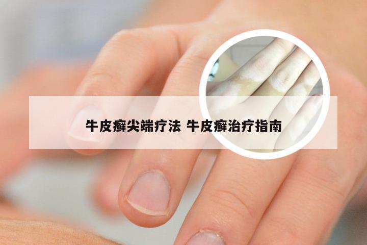 牛皮癣尖端疗法 牛皮癣治疗指南