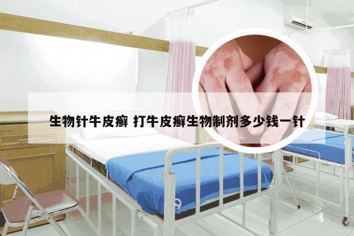 生物针牛皮癣 打牛皮癣生物制剂多少钱一针