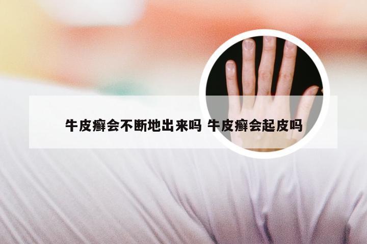 牛皮癣会不断地出来吗 牛皮癣会起皮吗