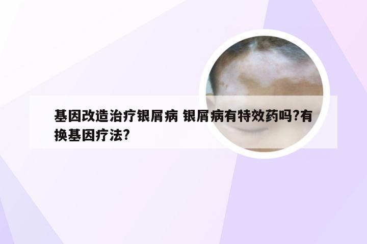 基因改造治疗银屑病 银屑病有特效药吗?有换基因疗法?