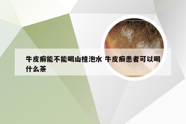 牛皮癣能不能喝山楂泡水 牛皮癣患者可以喝什么茶
