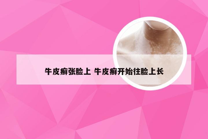 牛皮癣张脸上 牛皮癣开始往脸上长