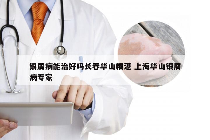 银屑病能治好吗长春华山精湛 上海华山银屑病专家