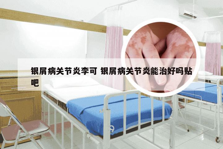 银屑病关节炎李可 银屑病关节炎能治好吗贴吧