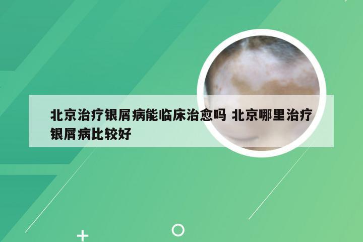 北京治疗银屑病能临床治愈吗 北京哪里治疗银屑病比较好