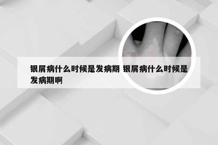银屑病什么时候是发病期 银屑病什么时候是发病期啊