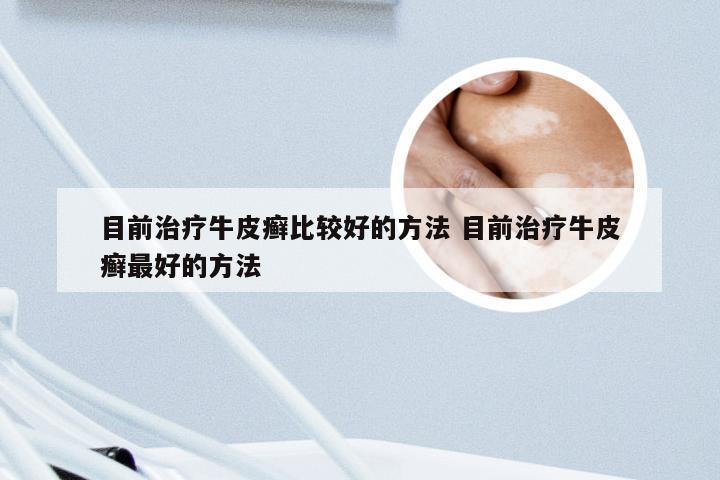 目前治疗牛皮癣比较好的方法 目前治疗牛皮癣最好的方法
