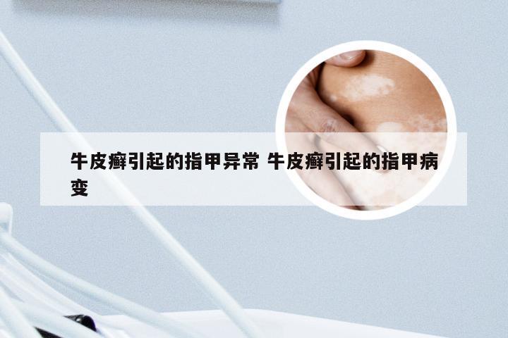 牛皮癣引起的指甲异常 牛皮癣引起的指甲病变