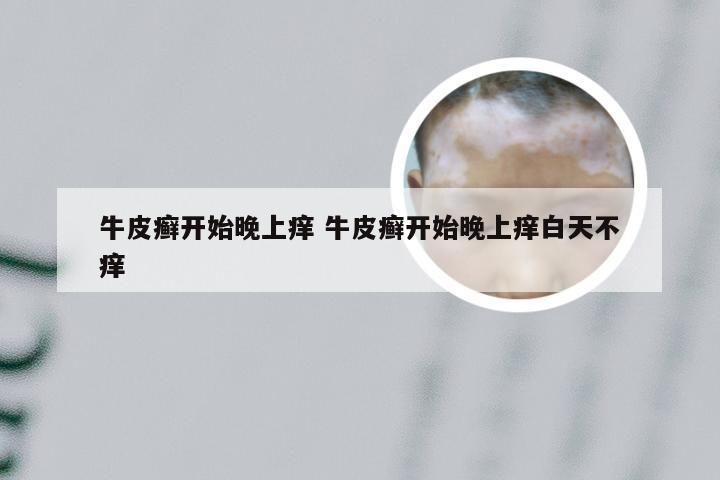 牛皮癣开始晚上痒 牛皮癣开始晚上痒白天不痒