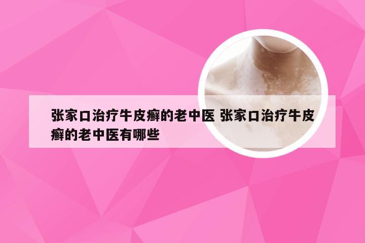 张家口治疗牛皮癣的老中医 张家口治疗牛皮癣的老中医有哪些