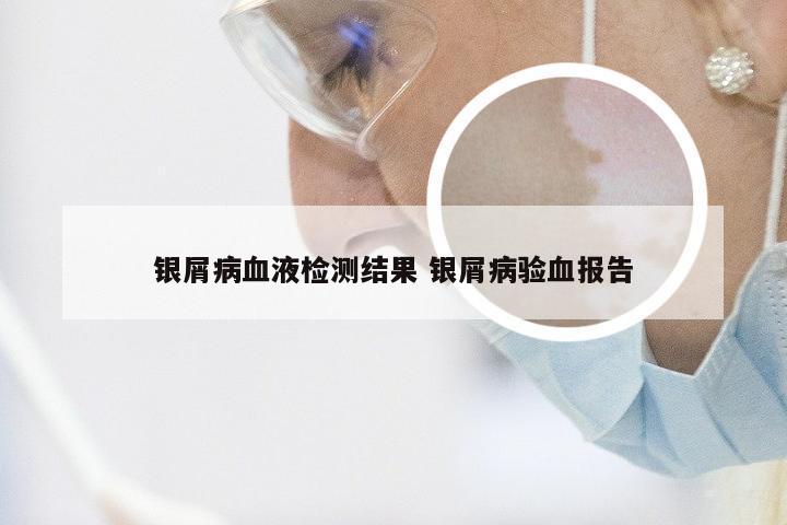 银屑病血液检测结果 银屑病验血报告
