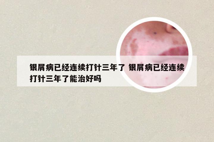 银屑病已经连续打针三年了 银屑病已经连续打针三年了能治好吗