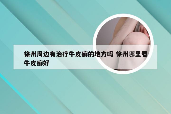 徐州周边有治疗牛皮癣的地方吗 徐州哪里看牛皮癣好
