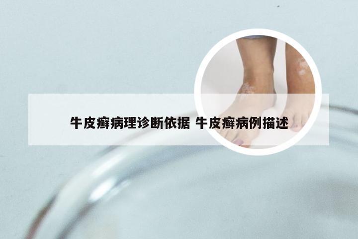 牛皮癣病理诊断依据 牛皮癣病例描述