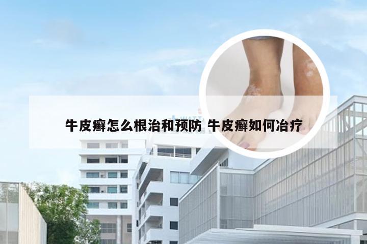 牛皮癣怎么根治和预防 牛皮癣如何冶疗