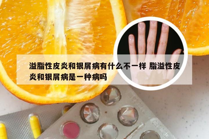 溢脂性皮炎和银屑病有什么不一样 脂溢性皮炎和银屑病是一种病吗