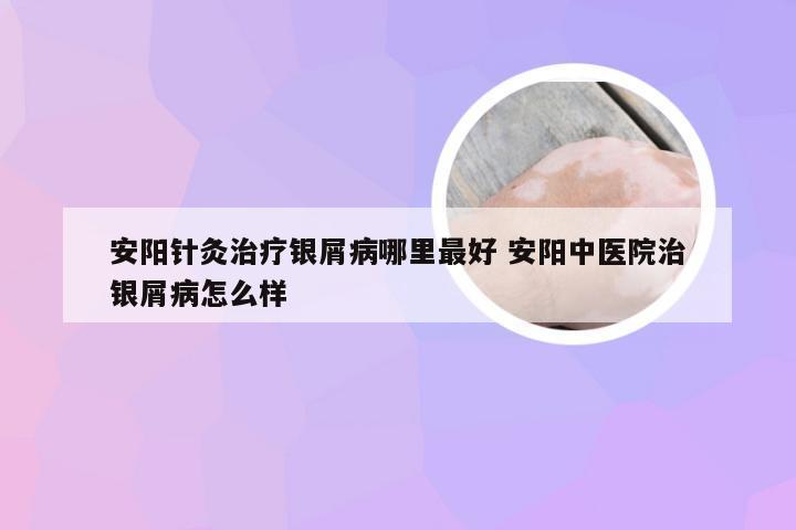 安阳针灸治疗银屑病哪里最好 安阳中医院治银屑病怎么样