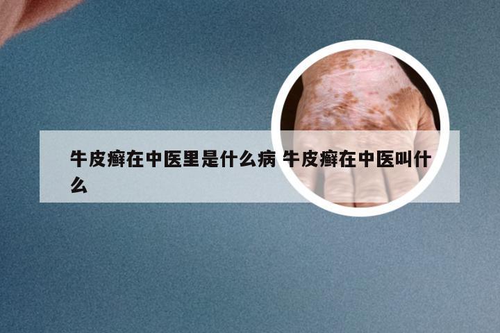 牛皮癣在中医里是什么病 牛皮癣在中医叫什么