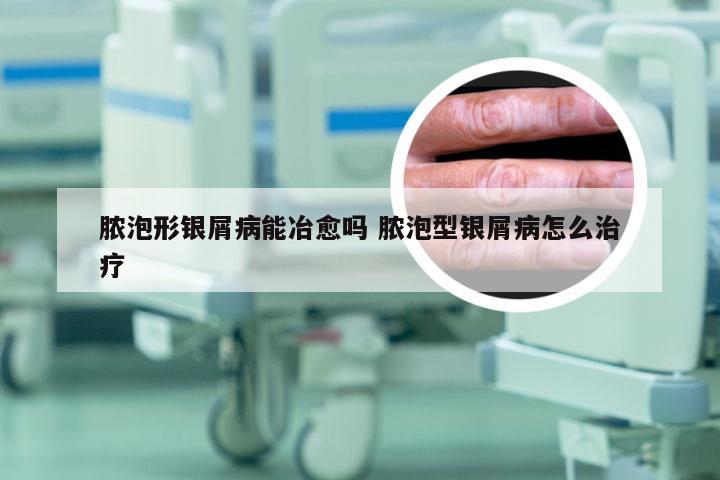 脓泡形银屑病能冶愈吗 脓泡型银屑病怎么治疗
