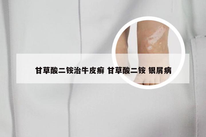 甘草酸二铵治牛皮癣 甘草酸二铵 银屑病