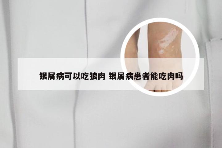 银屑病可以吃狼肉 银屑病患者能吃肉吗