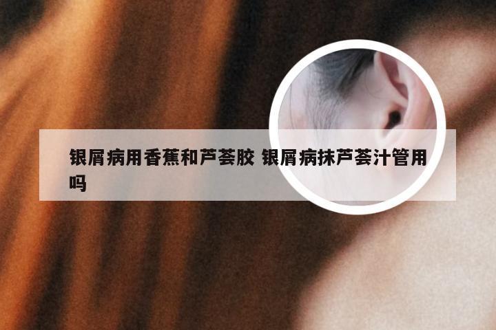 银屑病用香蕉和芦荟胶 银屑病抹芦荟汁管用吗