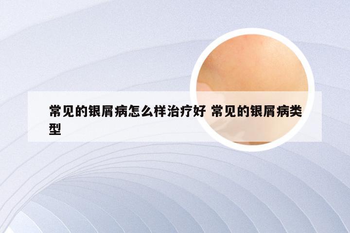 常见的银屑病怎么样治疗好 常见的银屑病类型