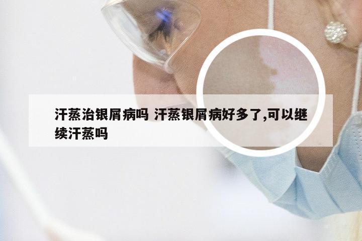 汗蒸治银屑病吗 汗蒸银屑病好多了,可以继续汗蒸吗