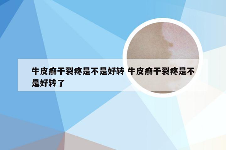 牛皮癣干裂疼是不是好转 牛皮癣干裂疼是不是好转了
