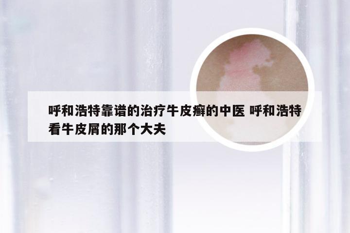 呼和浩特靠谱的治疗牛皮癣的中医 呼和浩特看牛皮屑的那个大夫